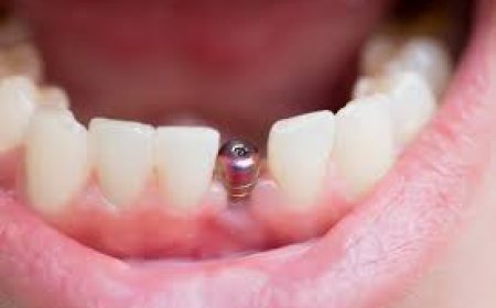 Managing Dental Implant Pain with Medications Like Aspadol Tablet