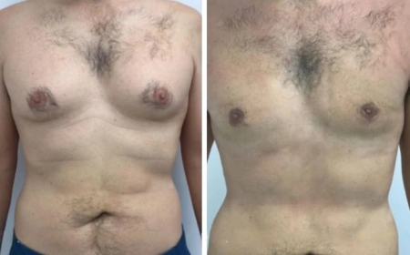 How the Best Gynecomastia Surgeons in Dubai Achieve Safe and Effective Results