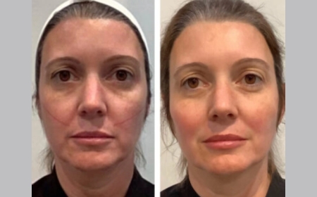 Thread Lift Treatment in Dubai for a Non-Surgical Brow Lift: How It Works