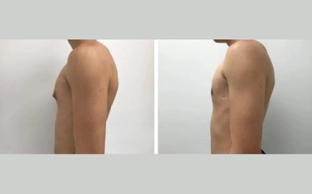How the Best Doctors in Dubai Provide Comprehensive Care for Gynecomastia Patients