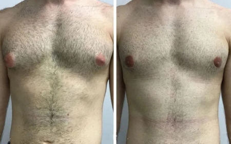 Latest Technology for Gynecomastia in Dubai