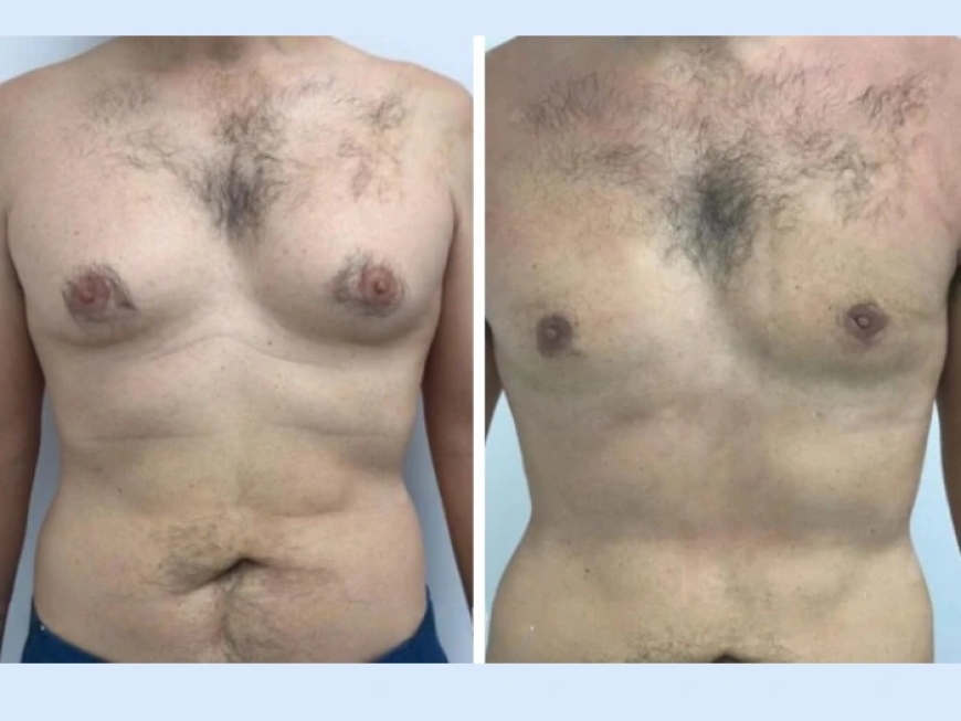 How the Best Gynecomastia Surgeons in Dubai Achieve Safe and Effective Results