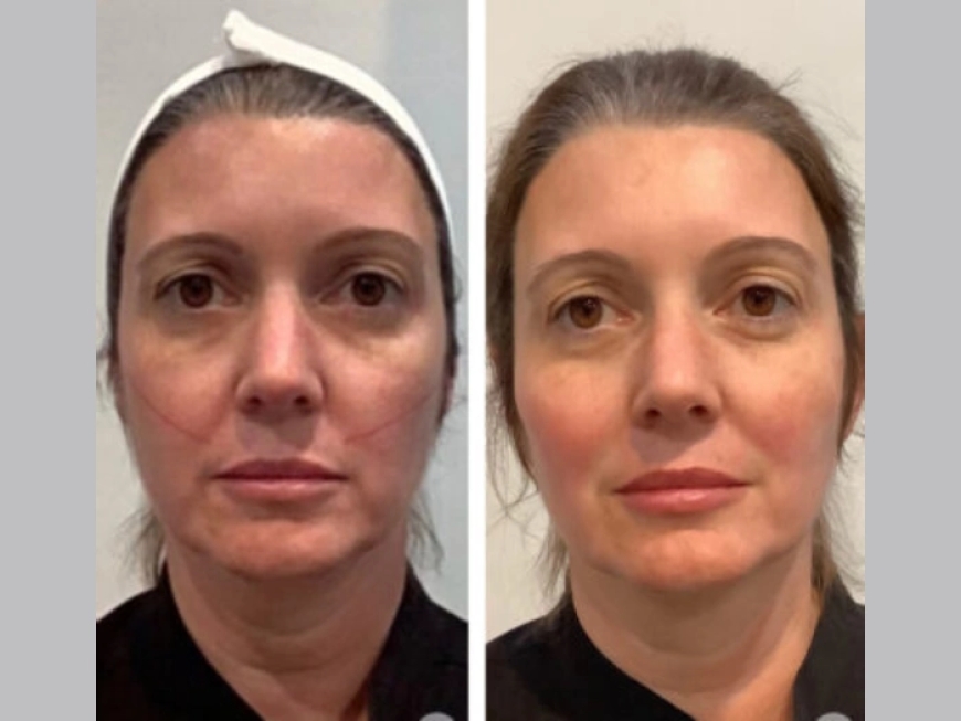 Thread Lift Treatment in Dubai for a Non-Surgical Brow Lift: How It Works
