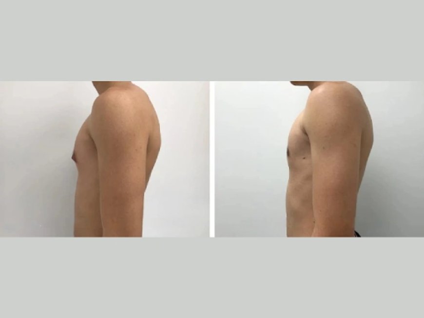 Laser Treatments for Gynecomastia in Dubai – Do They Work?