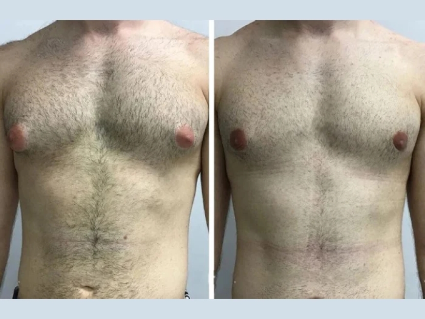 Top Surgeons for Gynecomastia in Dubai: What to Look For