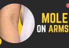 Mole on Arms: Meanings, Health Risks & Spiritual Insights