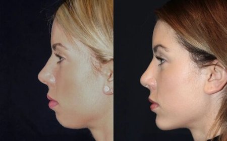 Chin Fillers in Dubai: Best Aesthetic Clinics for Chin Enhancement