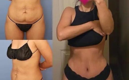 Best Doctors in Dubai for Tummy Tuck: Long-Term Results