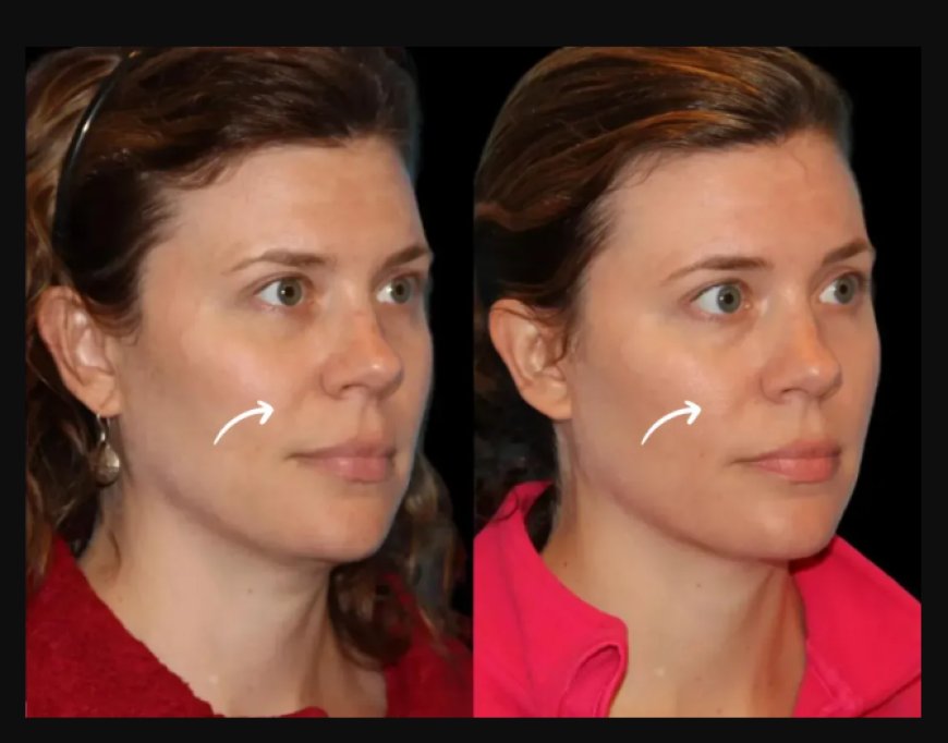 Best Aesthetic Clinic in Dubai Reveals Ideal Sculptra Fillers Schedule