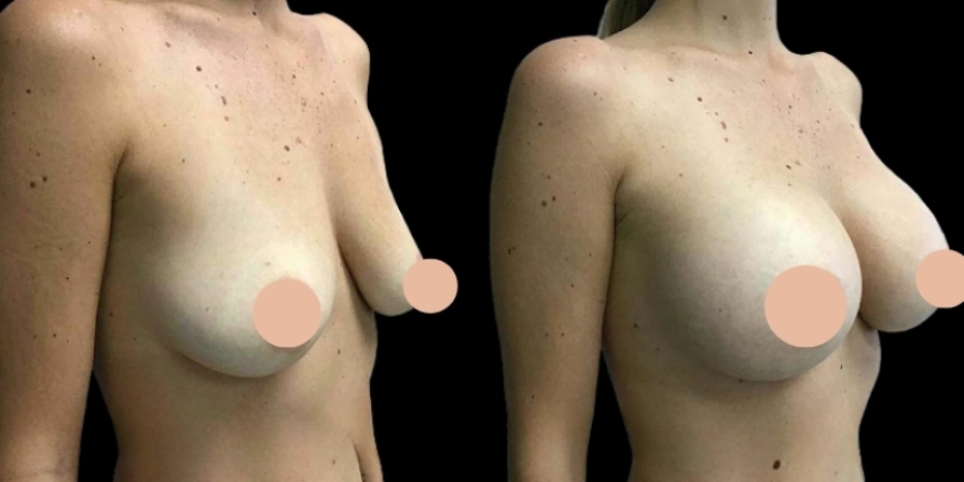 Best Breast Augmentation Surgeon in Dubai for Safe, Stunning Results