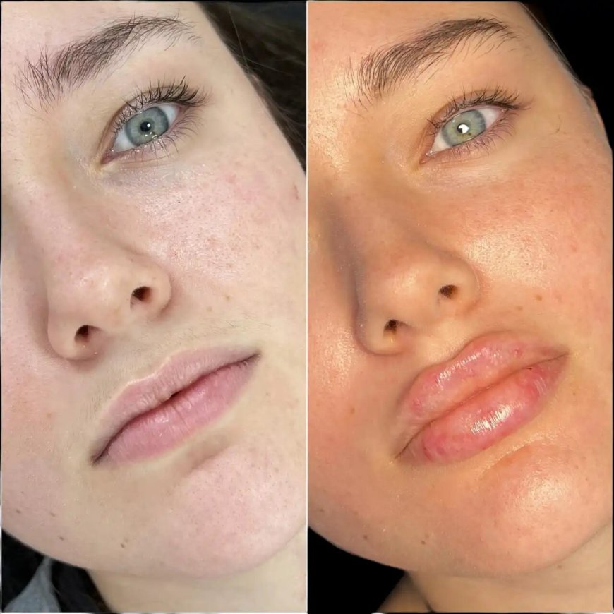 Fillers in Dubai: The Non-Surgical Way to Enhance Your Chin