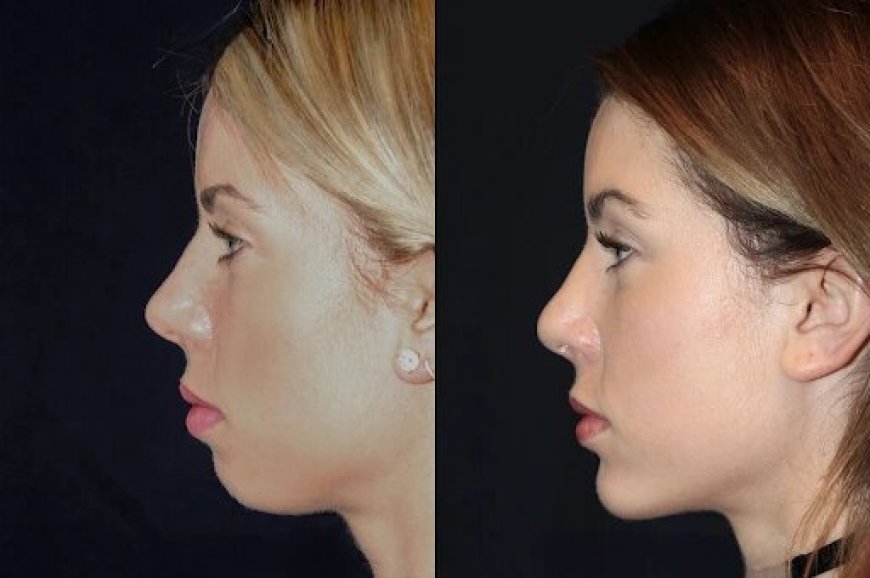 Chin Fillers in Dubai: Best Aesthetic Clinics for Chin Enhancement