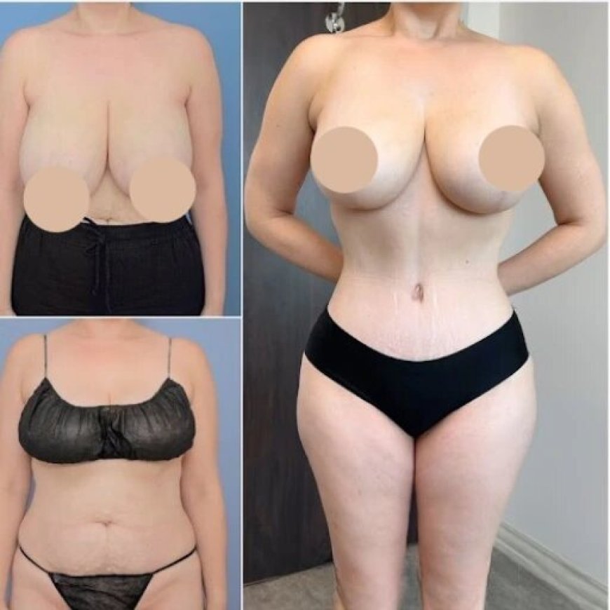 Best Doctors in Dubai for Body Contouring: Sculpting a New You