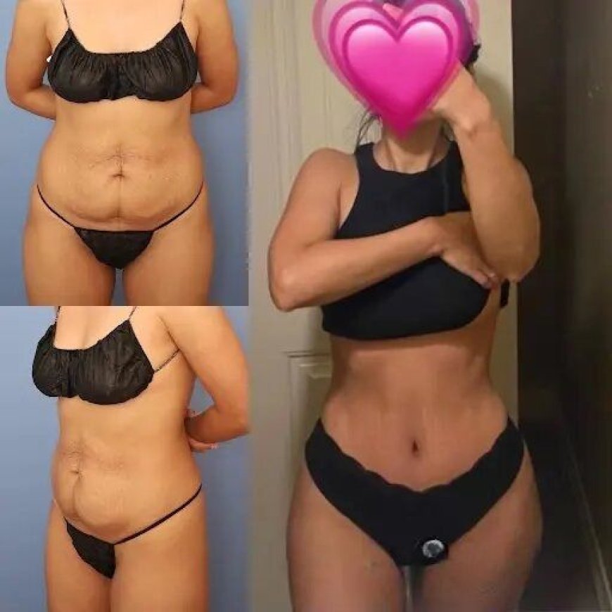 Best Doctors in Dubai for Tummy Tuck: Long-Term Results
