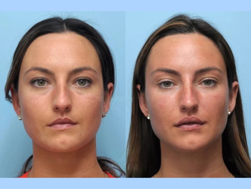 Thread Lift Mastery at the Best Aesthetic Clinics in Dubai