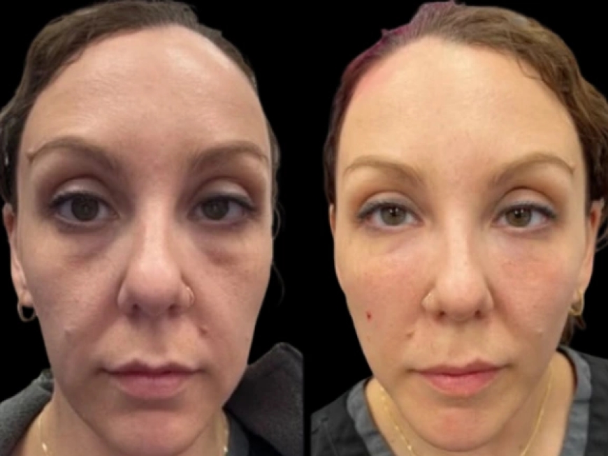 Dark Circles Treatment in Dubai: How to Select the Right Clinic and Expert for Treatment